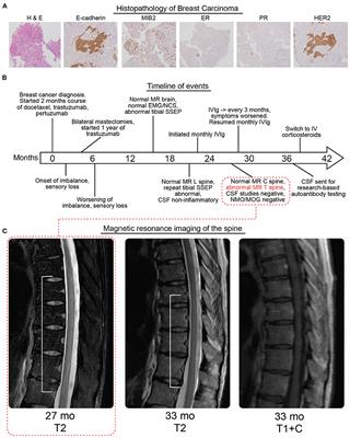 Case Report: A False Negative Case of Anti-Yo Paraneoplastic Myelopathy